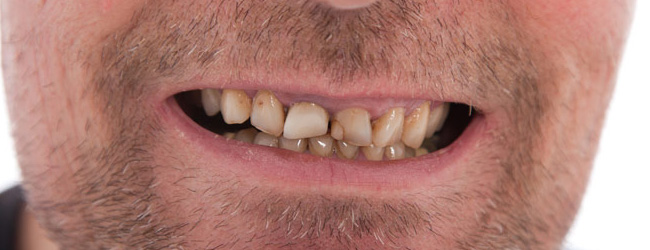 treating chipped and stained teeth