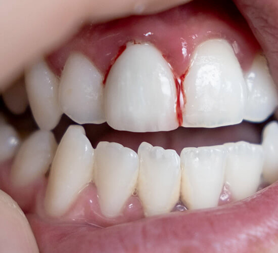 gum treatments