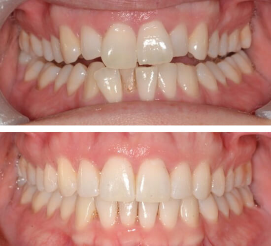 before and after cosmetic dental treatment