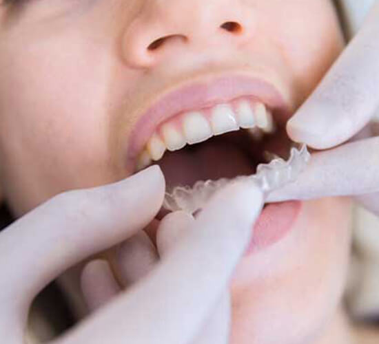 clear aligners in newton abbot